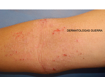 Dermatitis atpica