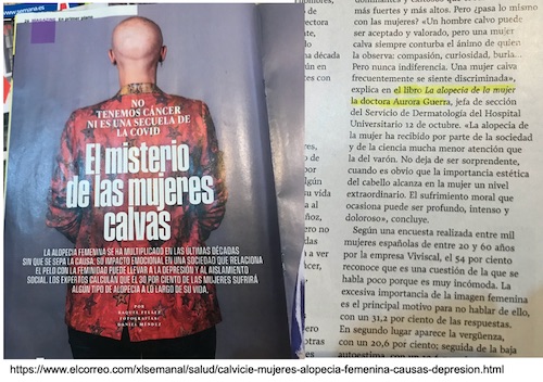 La alopecia de la mujer 